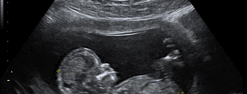 Ultrasound: Jabs Are Not the Only Cause of Autism